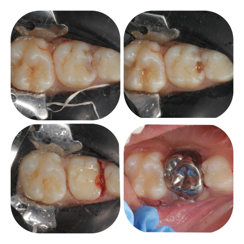 Dental Implants in Pune