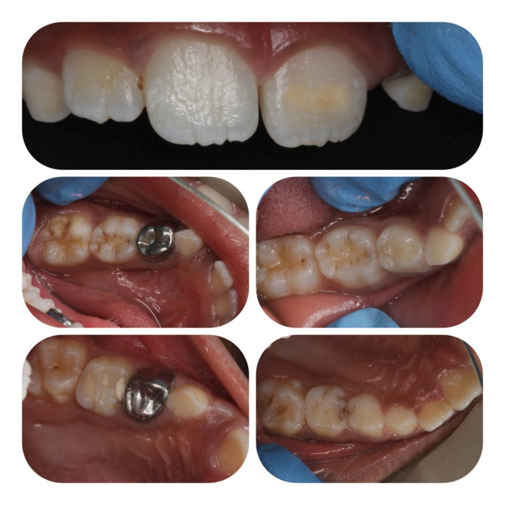 Orthodontics Treatment in Pune