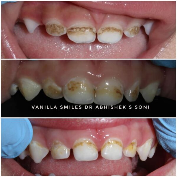 Lift the Lip and Prevent Early Childhood Caries