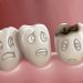 Management Of Deep Dental Caries