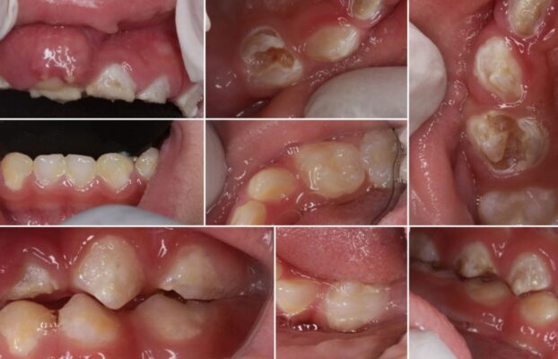 Journey of a 2.8 years old’s full mouth rehabilitation at Vanilla Smiles.