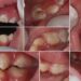 Dental Filling Treatment in Pune