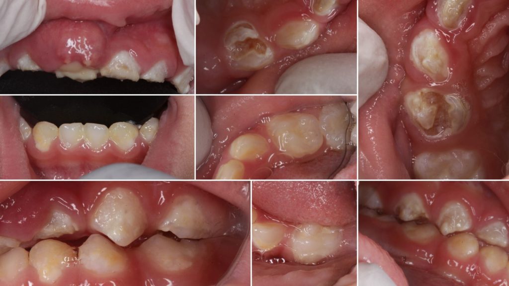 Journey of a 2.8 years old’s full mouth rehabilitation at Vanilla Smiles.