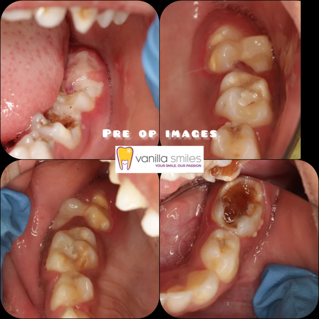 Wisdom Tooth removal in Shivaji Nagar