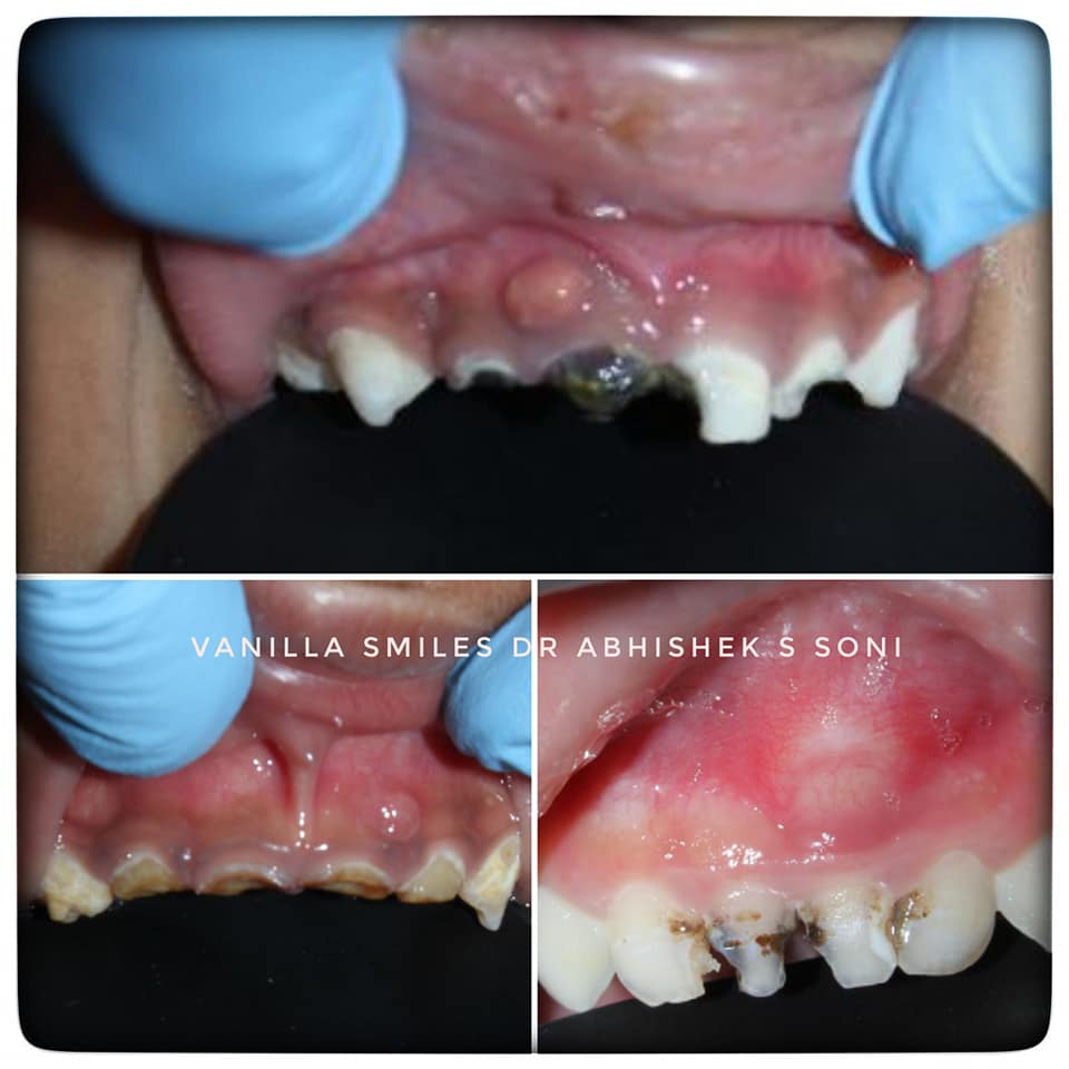 Root canal Treatment in Fc Road