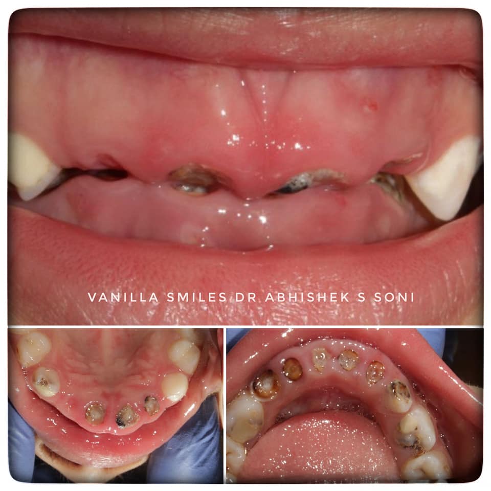 Orthodontic Treatment in Deccan