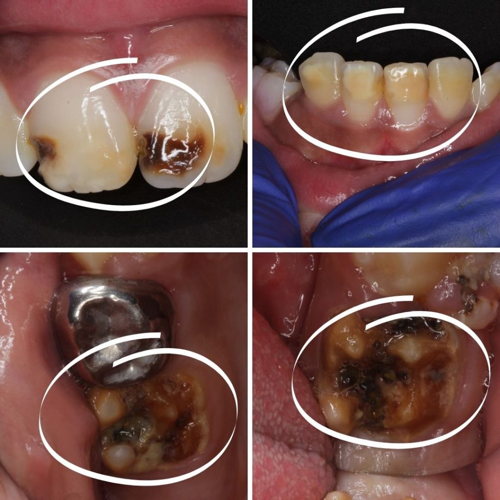 Orthodontic Treatment in Deccan