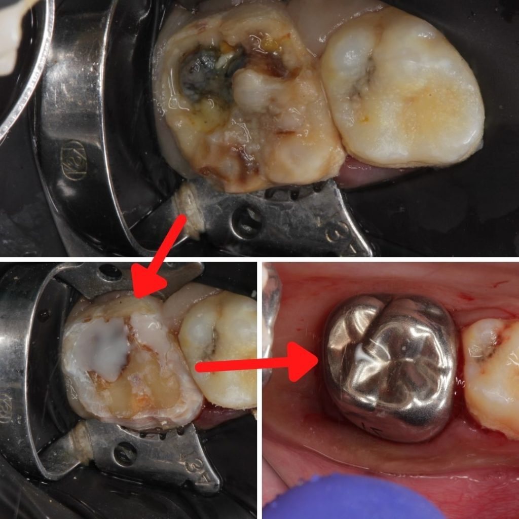 Dental Implants in Deccan