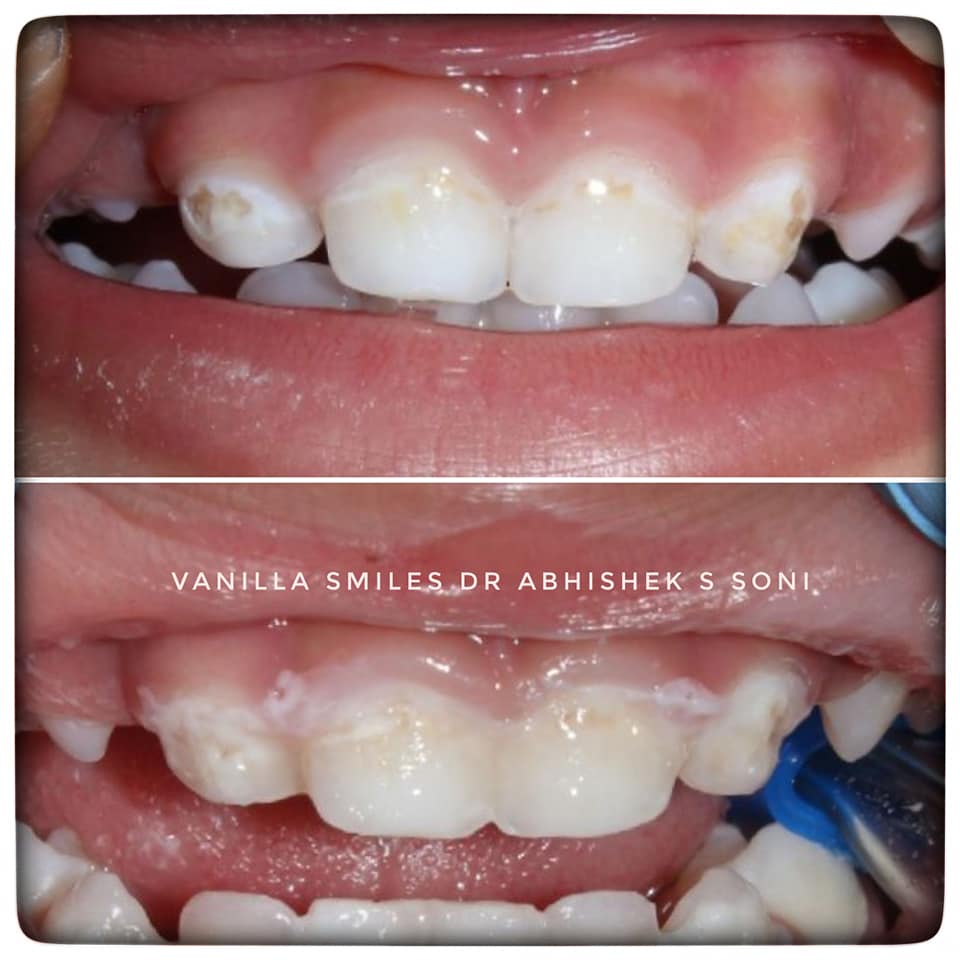 Management Of Precious Smile Of Your Child- Quadrant Dentistry