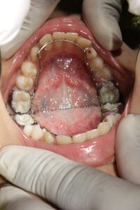 Teeth Braces Specialist in Pune