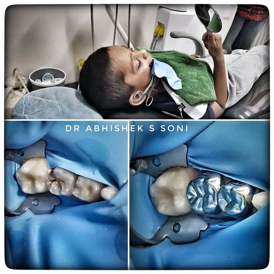 dental filling in Shivaji nagar