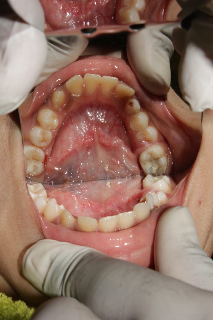 Space Maintainers in Shivaji Nagar Pune Vanilla smiles