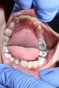 Tongue Tie Treatment in Pune