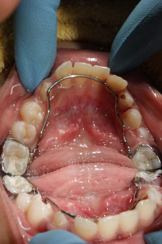 Space Maintainers in Shivaji Nagar Pune Vanilla smiles