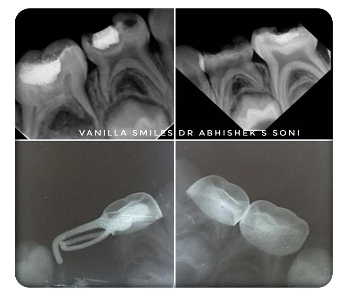 Dental Implants in Deccan