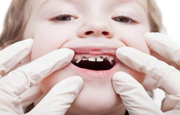 Kid’s Multiple Dental Cavities Treatment (full mouth rehabilitation) under IV sedation