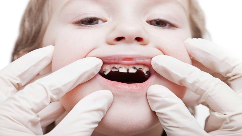 Kid’s Multiple Dental Cavities Treatment (full mouth rehabilitation) under IV sedation