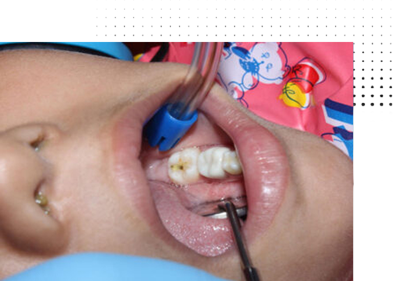 Preventive Resin Restoration and Sealants Vanilla Smile Dental Clinic