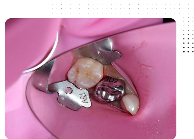 Painless Root Canal Treatment for Children in Pune Vanilla Smiles