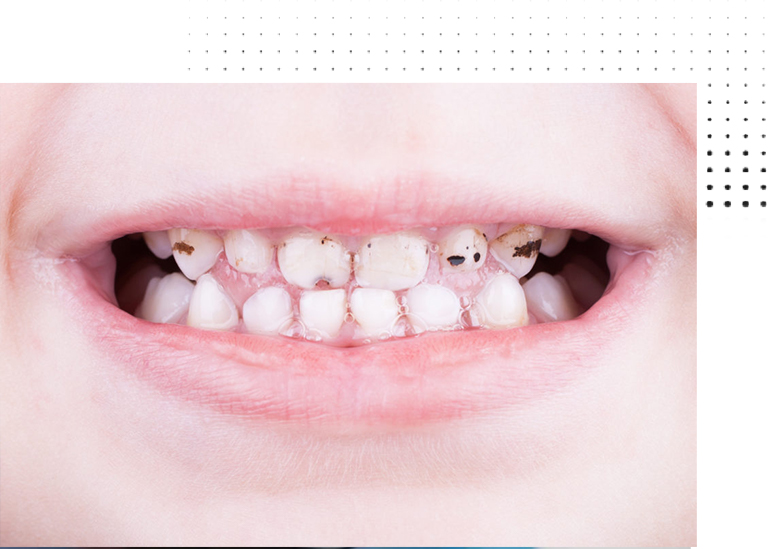 sdf-cavity-treatment-in-shivaji-nagar-pune-vanilla-smiles