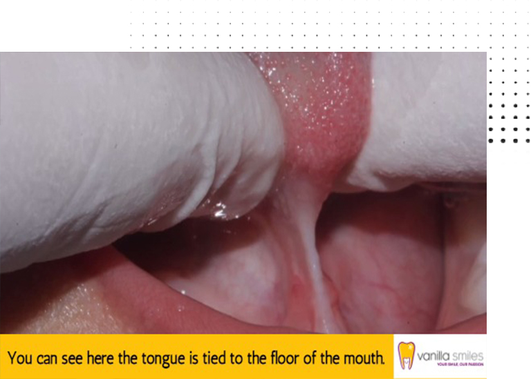 Tongue Tie Treatment in Shivaji Nagar, Pune