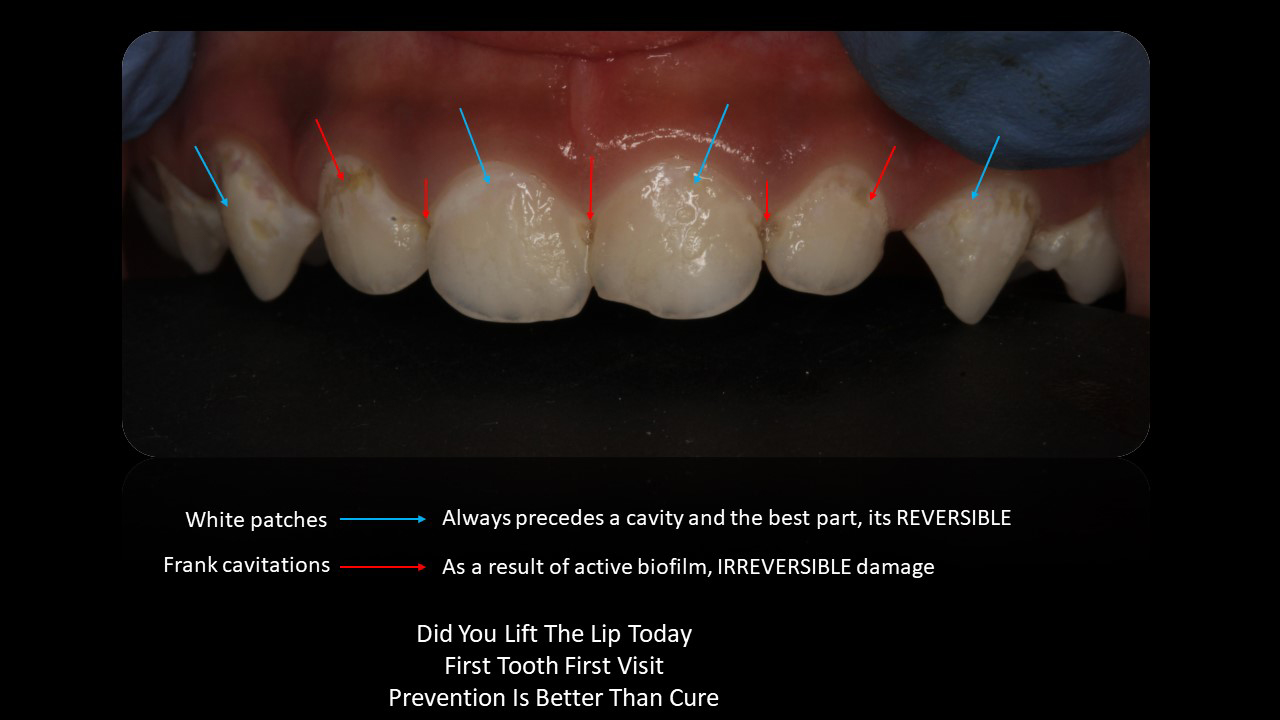 Lift the Lip and Prevent Early Childhood Caries