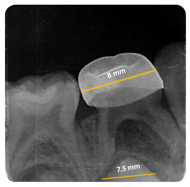 Tongue Tie Treatment in Deccan