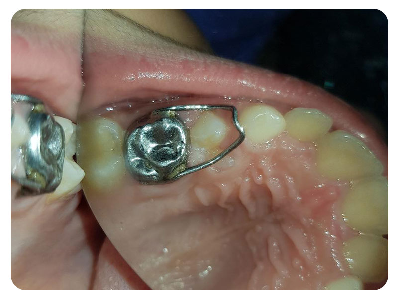 Dental Crowns in Fc road