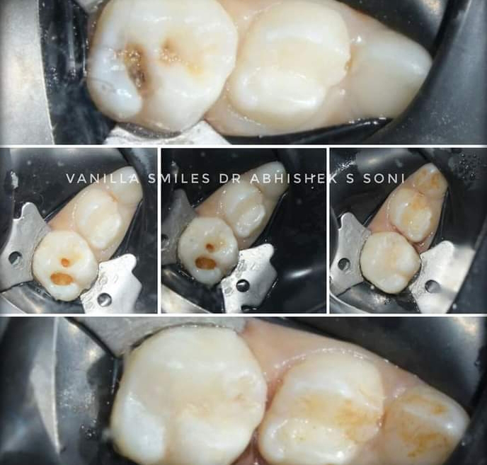 tooth coloured filling in FC Road