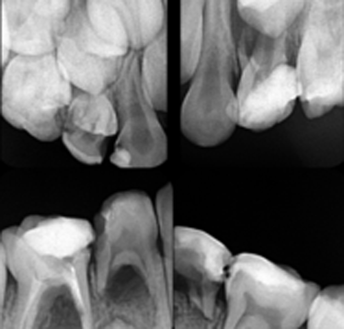 tooth coloured filling in deccan