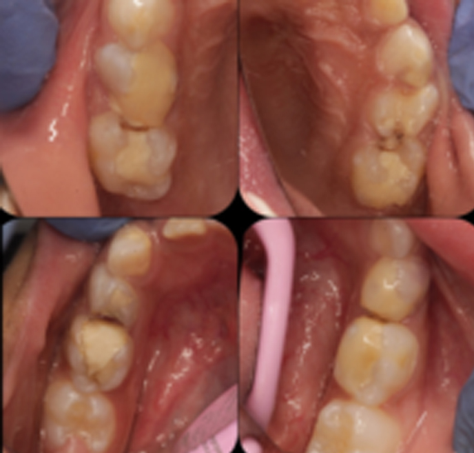 Wisdom Tooth Extraction in Fc Road