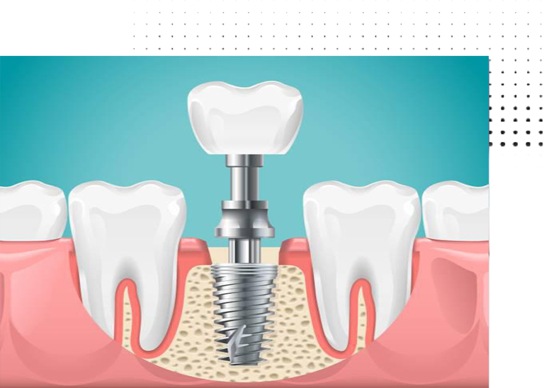 Tooth replacement / Dental Prosthetics Vanilla Smile Dental Clinic