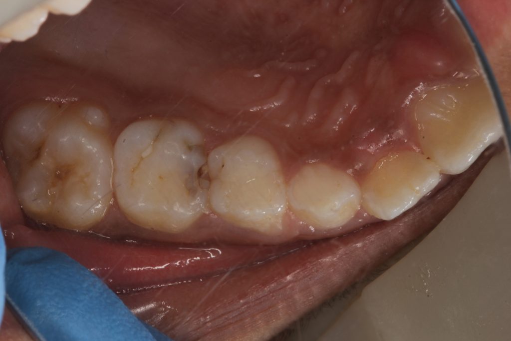 Wisdom Tooth removal in Shivaji Nagar