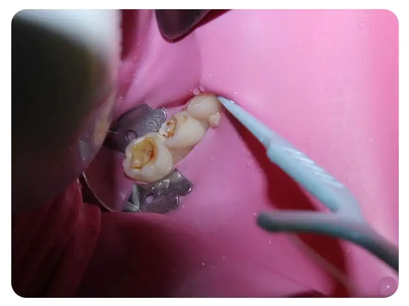 Dental Implants in Shivaji Nagar