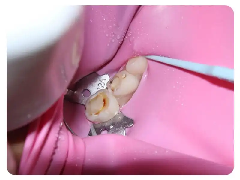 root canal treatment in Shivaji nagar