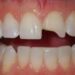 Traumatic dental injuries