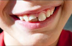 Teeth Braces Specialist in Shivaji Nagar
