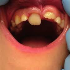 Dental Filling Treatment in Shivaji Nagar