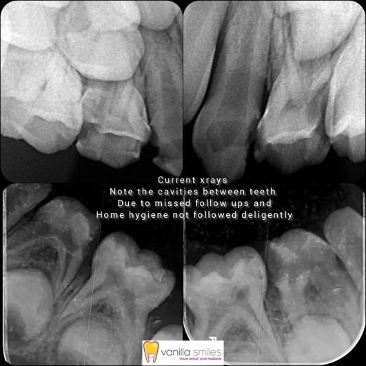 Dental Crowns in Fc road