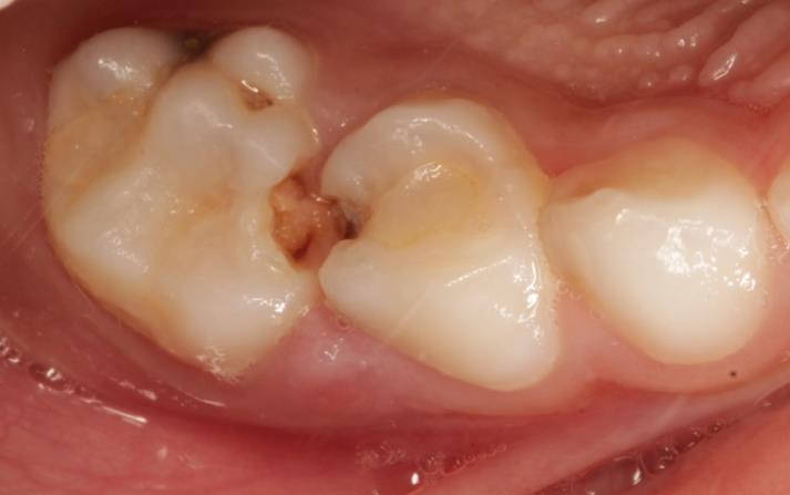 Class 2 Caries And Their Restoration - Vanilla Smiles Dental Clinic