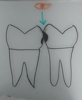 Root canal Treatment in Fc Road