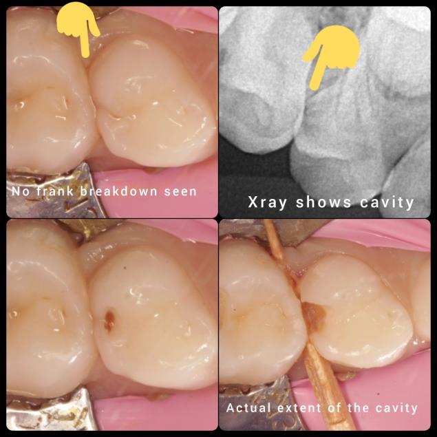 Root canal Treatment in Fc Road