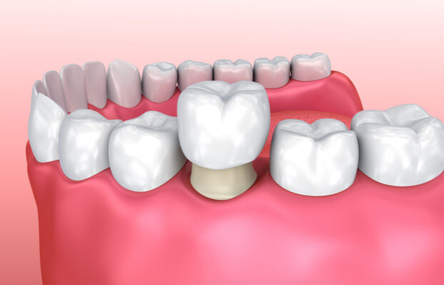 What are dental crowns? – Types and Needs
