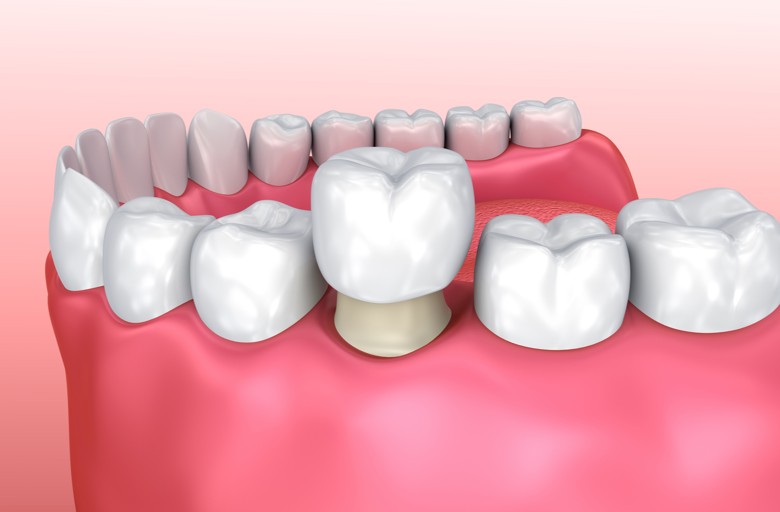 What are dental crowns? – Types and Needs