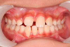 Best Dentist in Shivaji Nagar