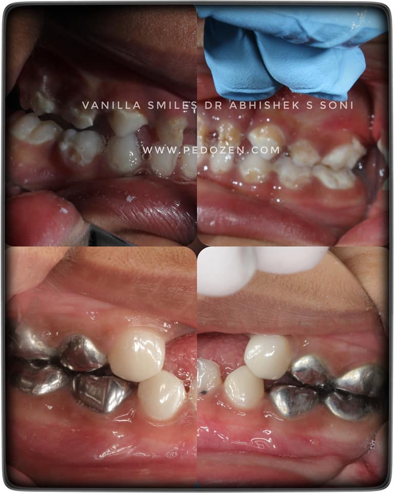 Dental Implants in Deccan