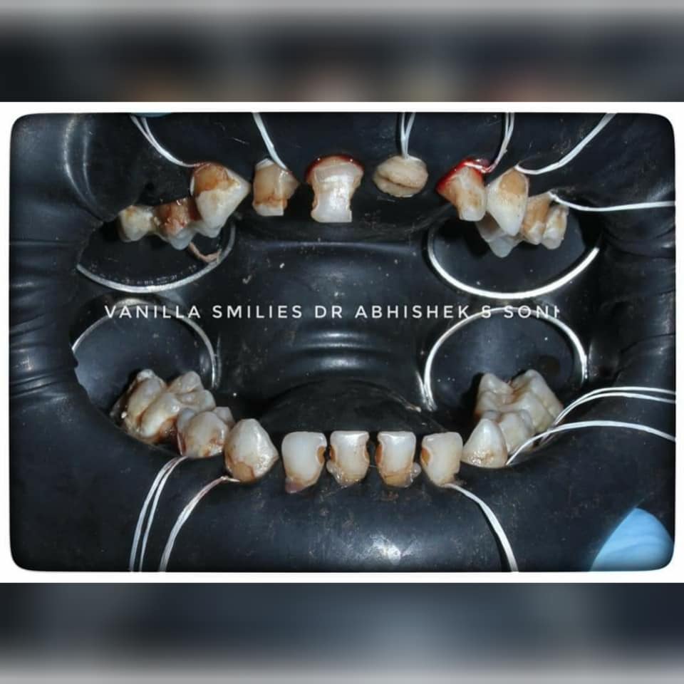 Dental Filling Treatment in Pune