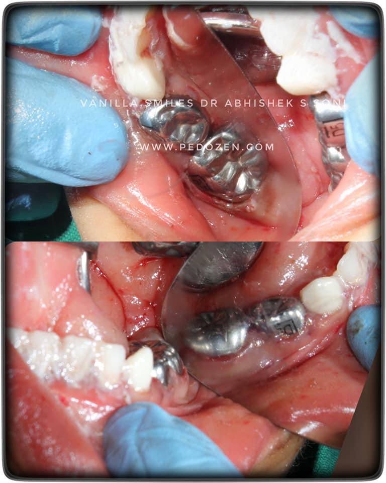 Dental Implants in Fc Road
