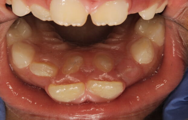 Choosing Vanilla Smiles for Full Mouth Rehabilitation Under General Anesthesia