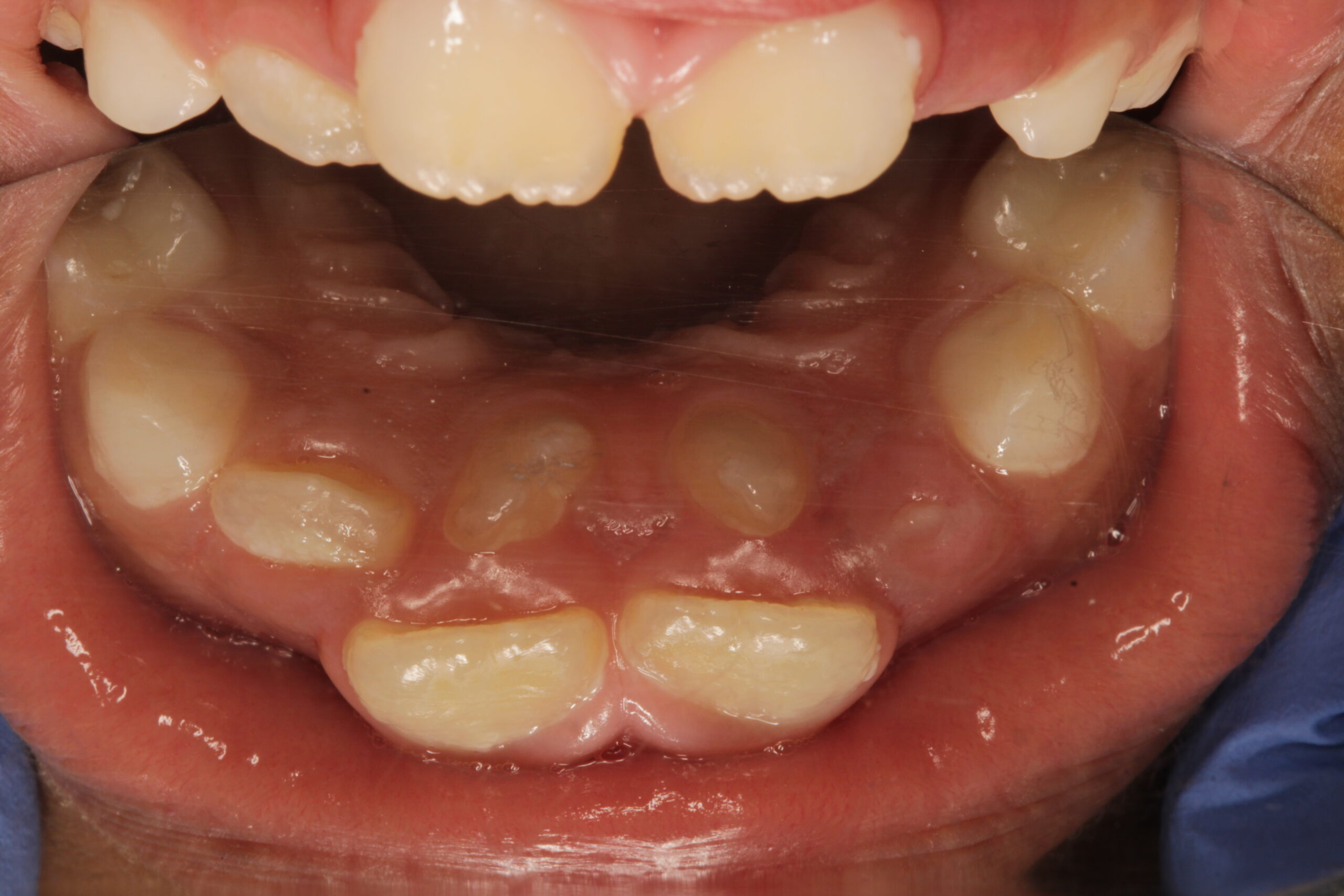 Choosing Vanilla Smiles for Full Mouth Rehabilitation Under General Anesthesia